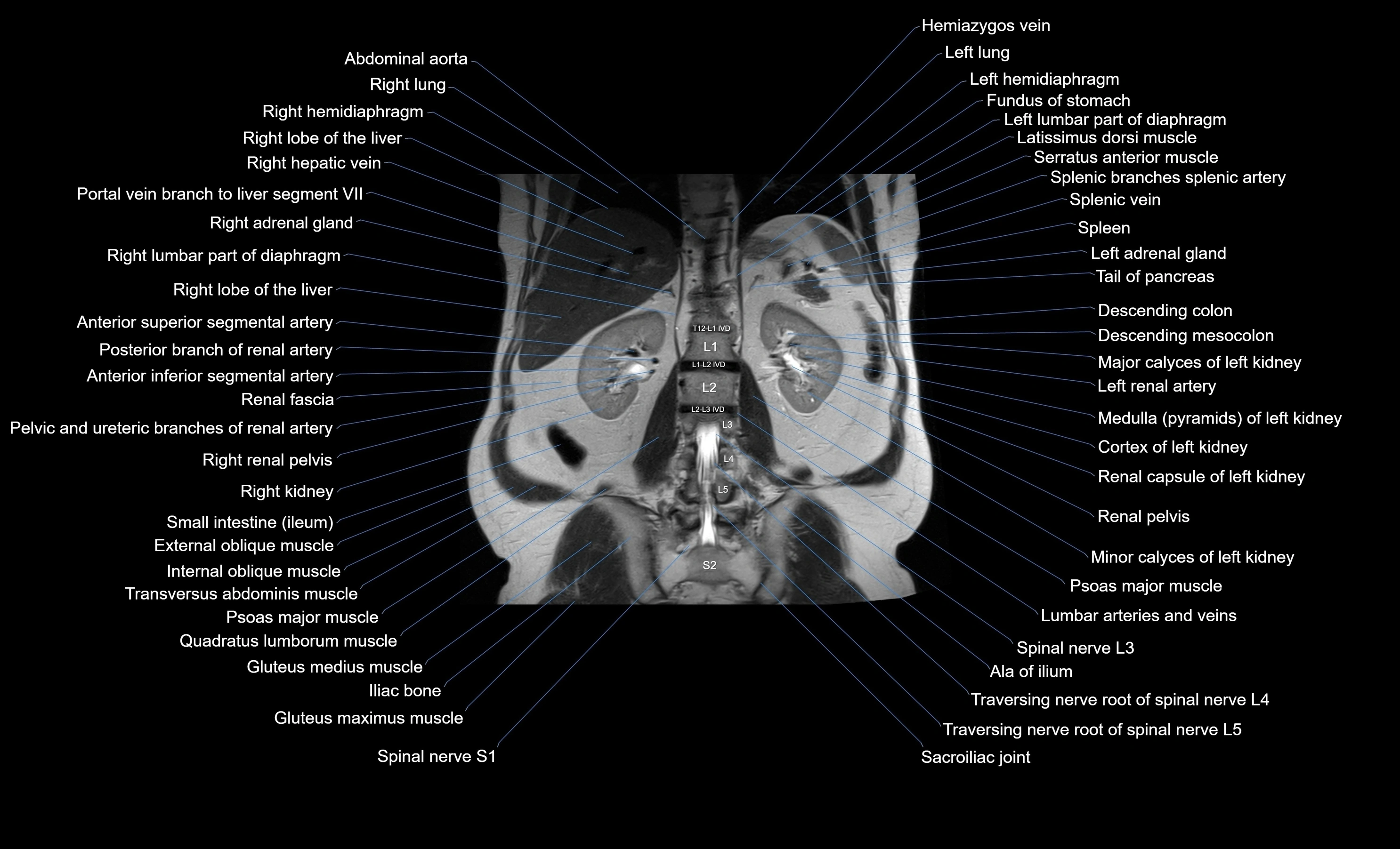 MRI Abdomen coronal labelled cross sectional anatomy radiology  image-img-00001-00040.webp